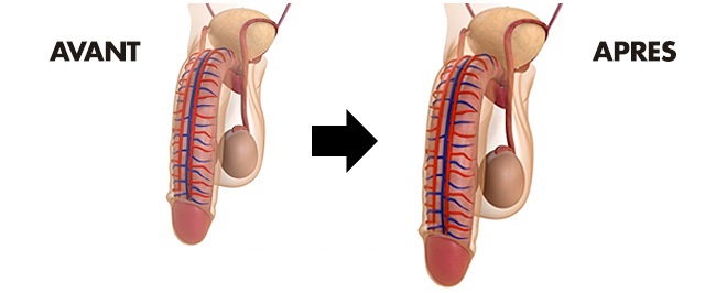 Pénis après cure de maleperf